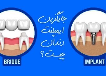 بهترین جایگزین ایمپلنت دندان چیست؟