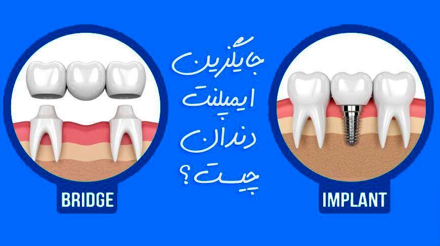 بهترین جایگزین ایمپلنت دندان چیست؟