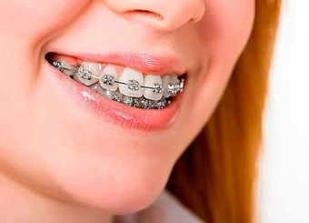 بهترین سن برای ارتودنسی دندان چه زمانی است؟